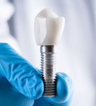 השתלות שיניים: למי הן מיועדות ומה הם היתרונות?-תמונה